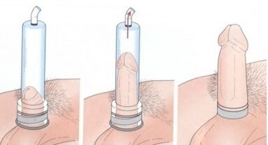 Penis enlargement using a pump