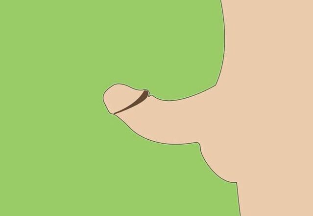 Penile curvature as an indication for enlargement surgery